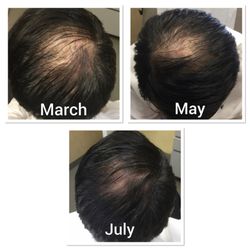 Injection Bar Medspa & Wellness - Hair restoration PRP