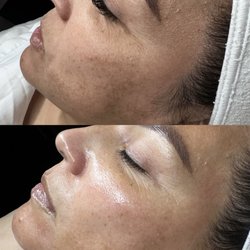 Lueur Skin - Hyperpigmentation transformation