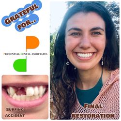 Prudential Dental Associates - Dental implant crown on front teeth