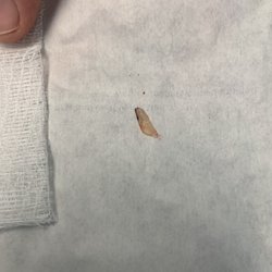 South Florida Podiatry - Removed toenail