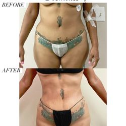 Beach Citiez Cosmetics - Liposuction.