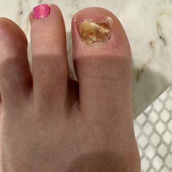 Allure Nails And Spray Tanning - Onychomycosis - Nail Salons Near Me - Winnetka, Illinois