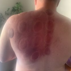 Zen Massage - Think the cups were left on a little too long.
