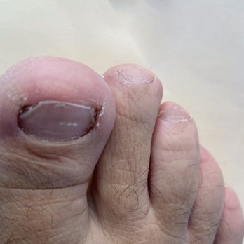 Concierge Podiatry and Spa - Before - Nail Salons Near Me - Costa Mesa, California Concierge Podiatry and Spa - Before - Nail Salons Near Me - Costa Mesa, California
