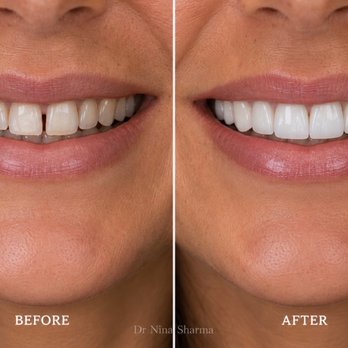OC Dental Specialists - Before and after with porcelain veneers. Custom veneers are shaped, shaded, and fitted to each tooth for a natural looking result. - Cosmetic Dentists Near Me - Irvine, California OC Dental Specialists - Before and after with porcelain veneers. Custom veneers are shaped, shaded, and fitted to each tooth for a natural looking result. - Cosmetic Dentists Near Me - Irvine, California