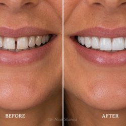 Before and after with porcelain veneers. Custom veneers are shaped, shaded, and fitted to each tooth for a natural looking result.