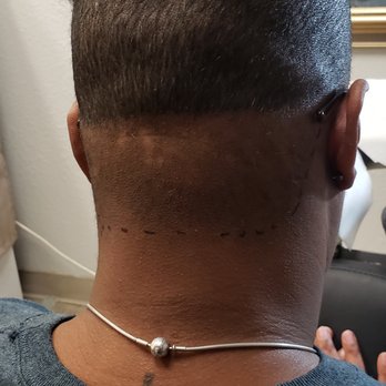 Royal Scalp Micro - Day of treatment - Hair Loss Centers Near Me - Albuquerque , New Mexico Royal Scalp Micro - Day of treatment - Hair Loss Centers Near Me - Albuquerque , New Mexico