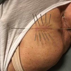 Balance Naturopathic & Acupuncture Clinic - This is a technique called Surround the Dragon. This is used to promote qi and blood circulation and reduce scar tissue.
