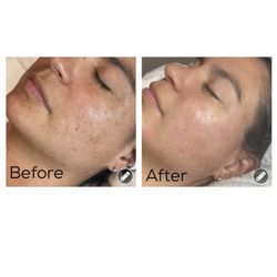 Virtue Holistic Skin Studio - Before and after: Organic Peel and Dermaplane