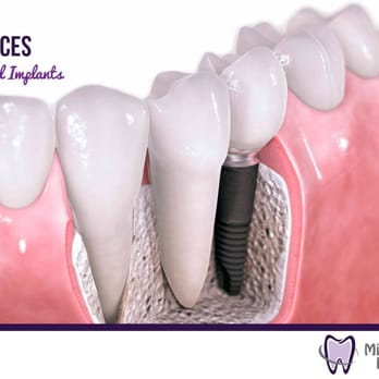 Millennium Dental Inc - Dr. Ivan Chicchon provides the latest in dental implants and restorative dentistry - Pediatric Dentists Near Me - Tracy, California Millennium Dental Inc - Dr. Ivan Chicchon provides the latest in dental implants and restorative dentistry - Pediatric Dentists Near Me - Tracy, California