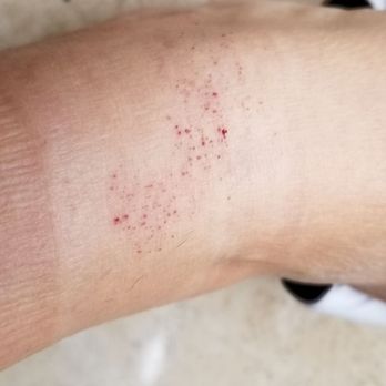 Josephine's Nail Spa - Callus removal with the skin - Nail Salons Near Me - Studio City, California Josephine's Nail Spa - Callus removal with the skin - Nail Salons Near Me - Studio City, California