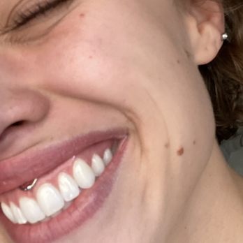 Barbella Studios - Smiley piercing done by Stephen. - Piercing Near Me - Costa Mesa, California Barbella Studios - Smiley piercing done by Stephen. - Piercing Near Me - Costa Mesa, California