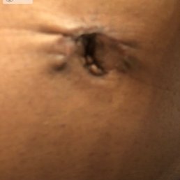 Belly button scar revision. Absolute disaster with erroneously applied suture that never dissolved, creating much more scar tissue.