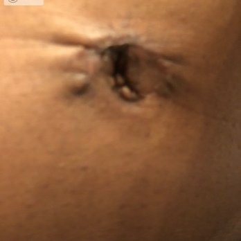 Joshua B Hyman, MD - Belly button scar revision. Absolute disaster with erroneously applied suture that never dissolved, creating much more scar tissue. - Cosmetic Surgeons Near Me - New York, New York