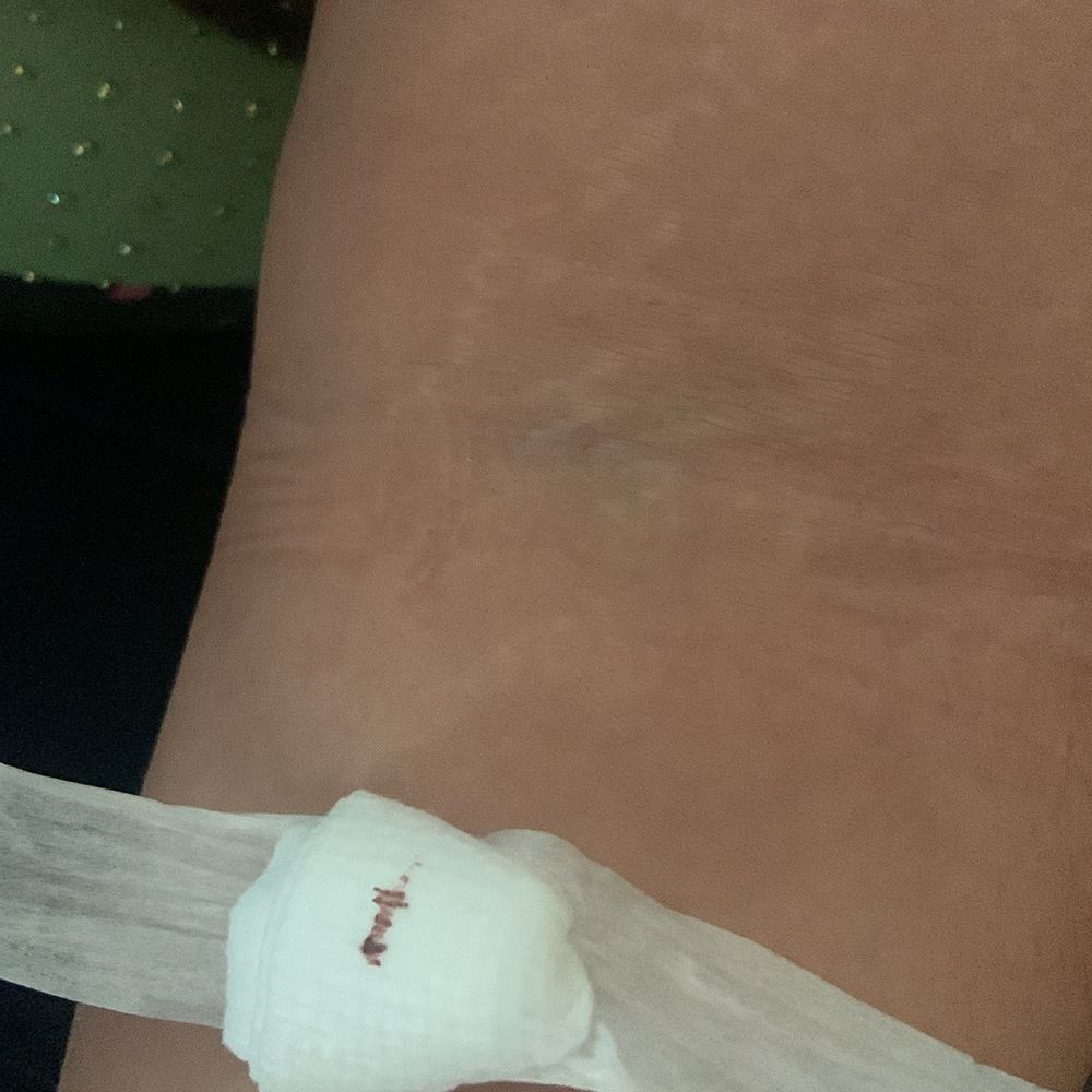 Quest Diagnostics - the bruise. - Laboratory Testing Near Me - Houston, Texas Quest Diagnostics - the bruise. - Laboratory Testing Near Me - Houston, Texas