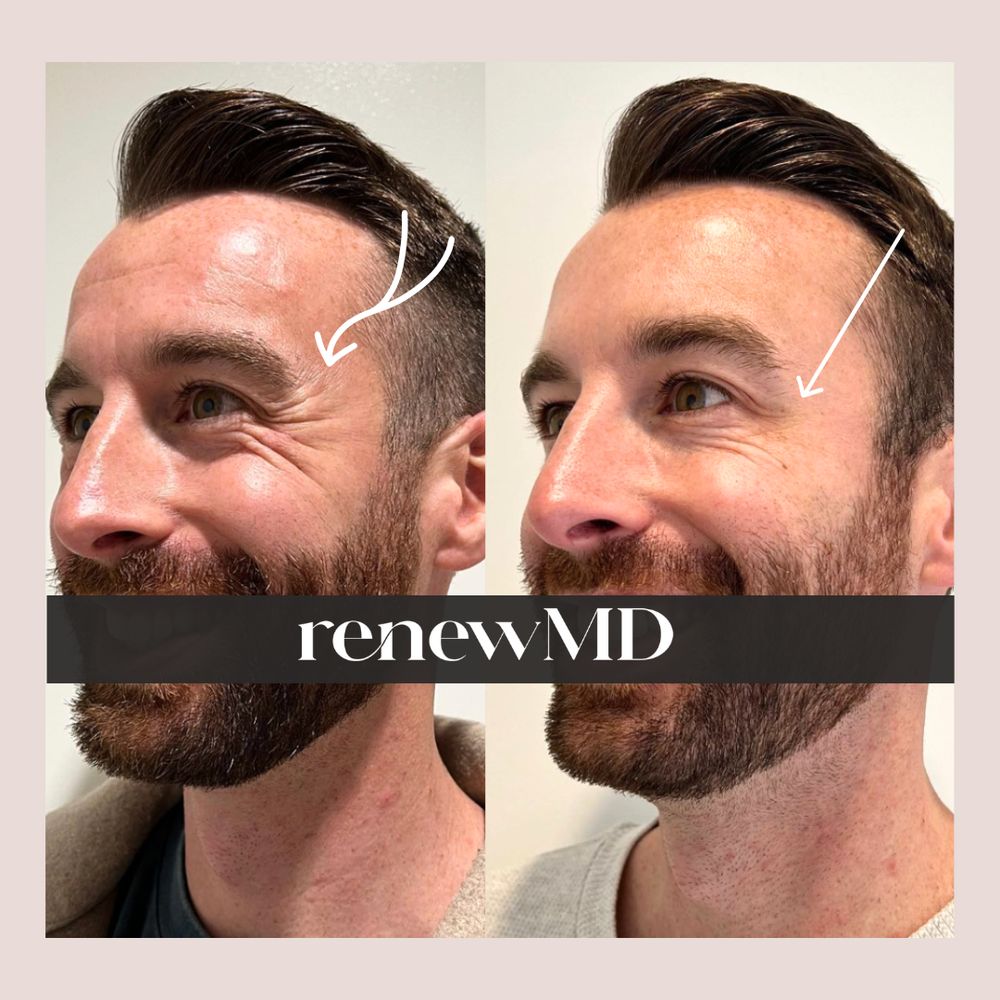RenewMD Logo