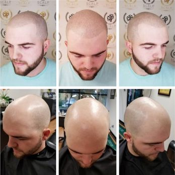 Scalp Micropigmentation - Hair Loss Centers Near Me - Kensington, Maryland
