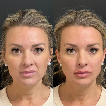 Skin MD - Facial fillers restore volume, enhance facial structure, & smooth deeper lines--perfect for cheeks, jawline, under-eyes, and more. - Skin Care Near Me - Seekonk, Massachusetts Skin MD - Facial fillers restore volume, enhance facial structure, & smooth deeper lines--perfect for cheeks, jawline, under-eyes, and more. - Skin Care Near Me - Seekonk, Massachusetts