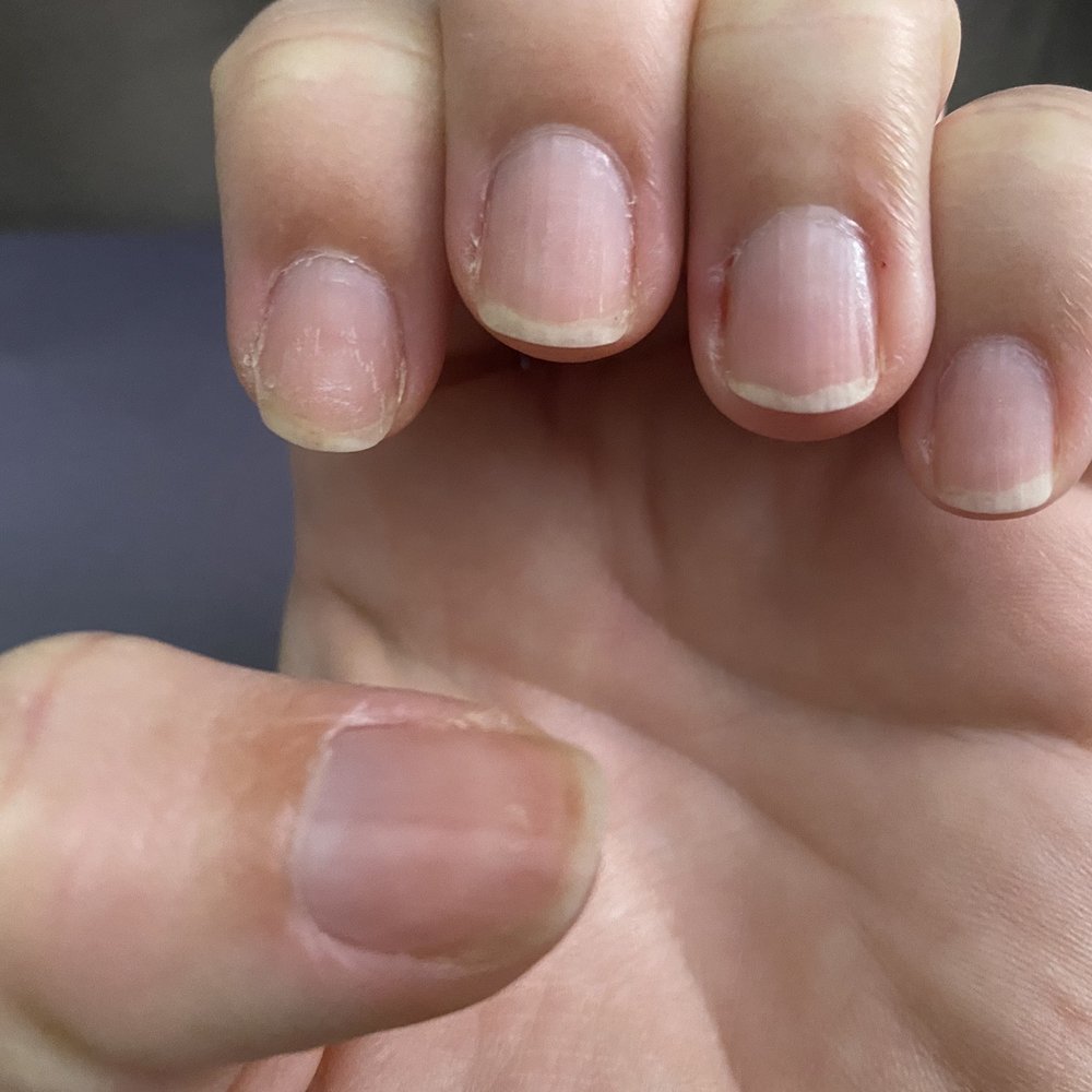 Future Nail & Spa - This is what my nails look like 4 days after their crummy manicure. I have hang nails that are inflamed. They really did a terrible job! - Nail Salons Near Me - Huntsville, Alabama