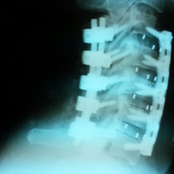 Haider Spine Center - This is my neck after surgery. - Physical Therapy Near Me - Riverside, California