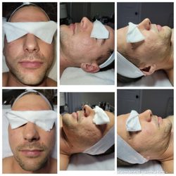 Elemental Aesthetics - Microneedling
bottom before
Top 1 month after 1st session.