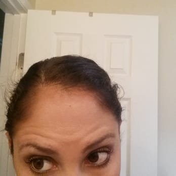 Prestige Med - I look like a mad dog. This is AFTER botox, and after asking them to "correct" this issue.Keep your money and go elsewhere. - Laser Hair Removal Near Me - San Ramon, California