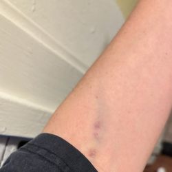 Quest Diagnostics - blown vein