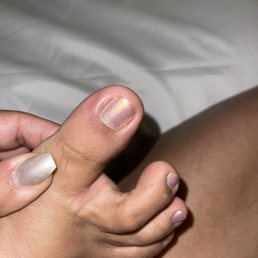 Infected big toe! She lifted nail off toe and filed it to a stub lifting up the nail, and harassed it with possible unclean tools! Infected big toe! She lifted nail off toe and filed it to a stub lifting up the nail, and harassed it with possible unclean tools!