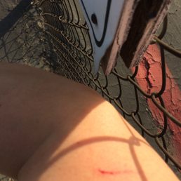 PHOTO 1 OF 4: The cut on my arm caused by the damaged sign (please see review for details) PHOTO 1 OF 4: The cut on my arm caused by the damaged sign (please see review for details)