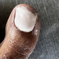 Arlington Foot and Ankle - What the unlicensed receptionist did to my toe.