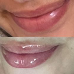 Chase Lay, MD - 1ML of lip fillers from Sie