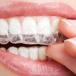 NJ Dental 1 - Teeth Whitening