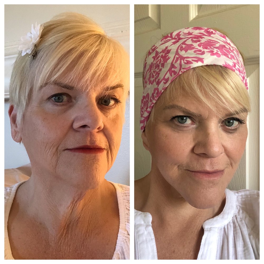Before and 6 Months Post-Op