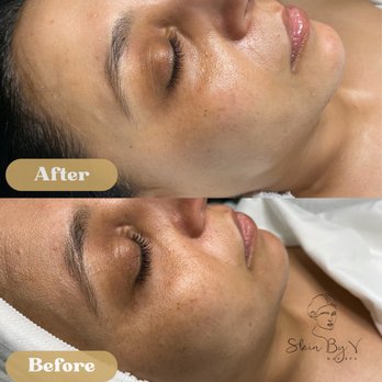 Skin BY V - one session nano-needling - Skin Care Near Me Skin BY V - one session nano-needling - Skin Care Near Me