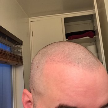 The Scalp Shop | New York Scalp Micropigmentation - Right hairline one week after treatment. - Hair Loss Centers Near Me - New York, New York The Scalp Shop | New York Scalp Micropigmentation - Right hairline one week after treatment. - Hair Loss Centers Near Me - New York, New York