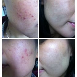 Bianca Skin Care - Acne treatment