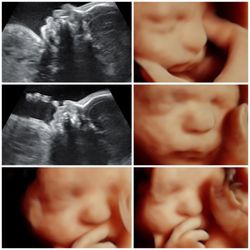 Baby Bound Ultrasound - 30 weeks HD LIVE