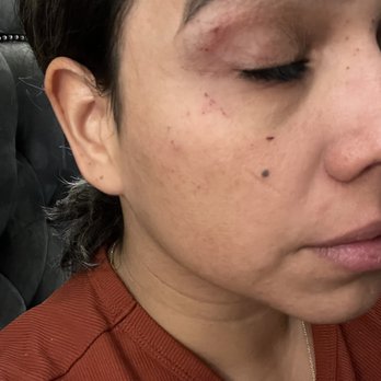B&B THREADING - Full face threading and the skin damage they left on my face, two weeks before my wedding. - Threading Services Near Me - Chandler, Arizona