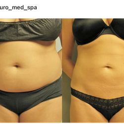 Euro Med Spa - GPS Lipo