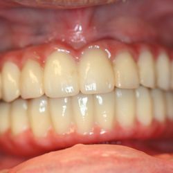 The Center for Dental Implants - Implant case