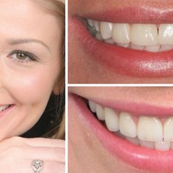 AnaBella Family and Cosmetic Dentistry - Before and After, Full mouth reconstruction.