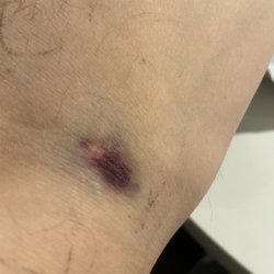 New Jersey Imaging Network of Union City - Swollen and more bruised as time goes on