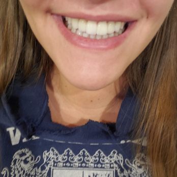 Pamela Marzban - Dr. Sirlanli's work - Cosmetic Dentists Near Me - Burke, Virginia Pamela Marzban - Dr. Sirlanli's work - Cosmetic Dentists Near Me - Burke, Virginia