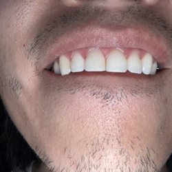 Bolsa Dental - One of these teeth isn't real! Bolsa dental does great work