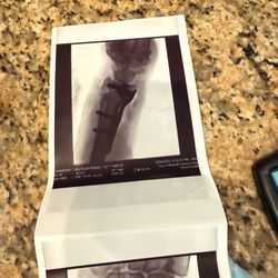 Texas Orthopedics Surgery Center - Hardware but doesn't set off alarm at airport!