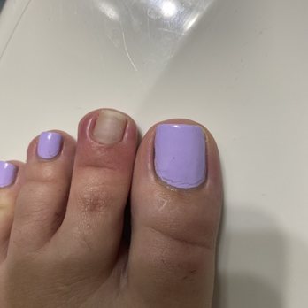 UT Nails & Spa - My infected toe from pedicure - Nail Salons Near Me - San Diego, California UT Nails & Spa - My infected toe from pedicure - Nail Salons Near Me - San Diego, California