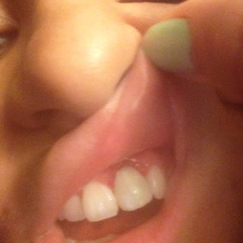 Paul Eliazo, DDS - Amazing progression thanks to Dr. Eliazo and Dr Tucker's input, still healing. - General Dentistry Near Me - Suffern, New York Paul Eliazo, DDS - Amazing progression thanks to Dr. Eliazo and Dr Tucker's input, still healing. - General Dentistry Near Me - Suffern, New York