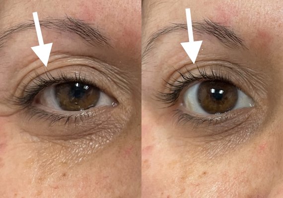 Upneeq for Upper Eyelids - These eye drops will help retract the upper eyelids for 8 hours. Can be used daily or for special occasions. Upneeq for Upper Eyelids - These eye drops will help retract the upper eyelids for 8 hours. Can be used daily or for special occasions.