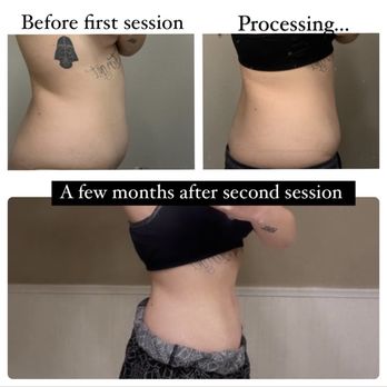 OrangeTwist - Brea - Before coolsculpting, during and after my second session - Medical Spas Near Me - Brea, California