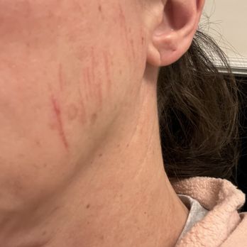 Express Med Spa La Grange - This is my face after dermaplaning. I've had this done hundreds of times at other places with no issues. - Skin Care Near Me - La Grange, Illinois